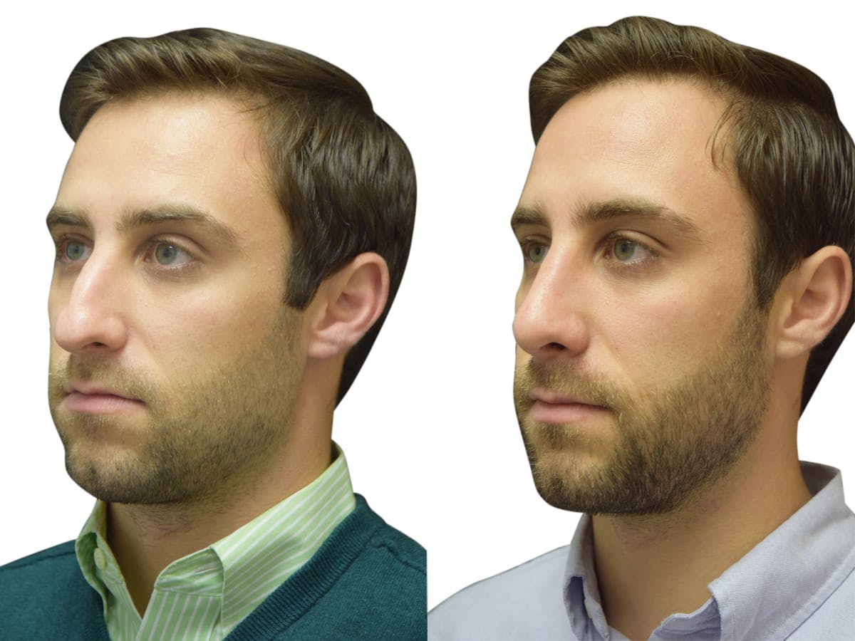 Rhinoplasty Before & After Gallery - Patient 310603 - Image 2