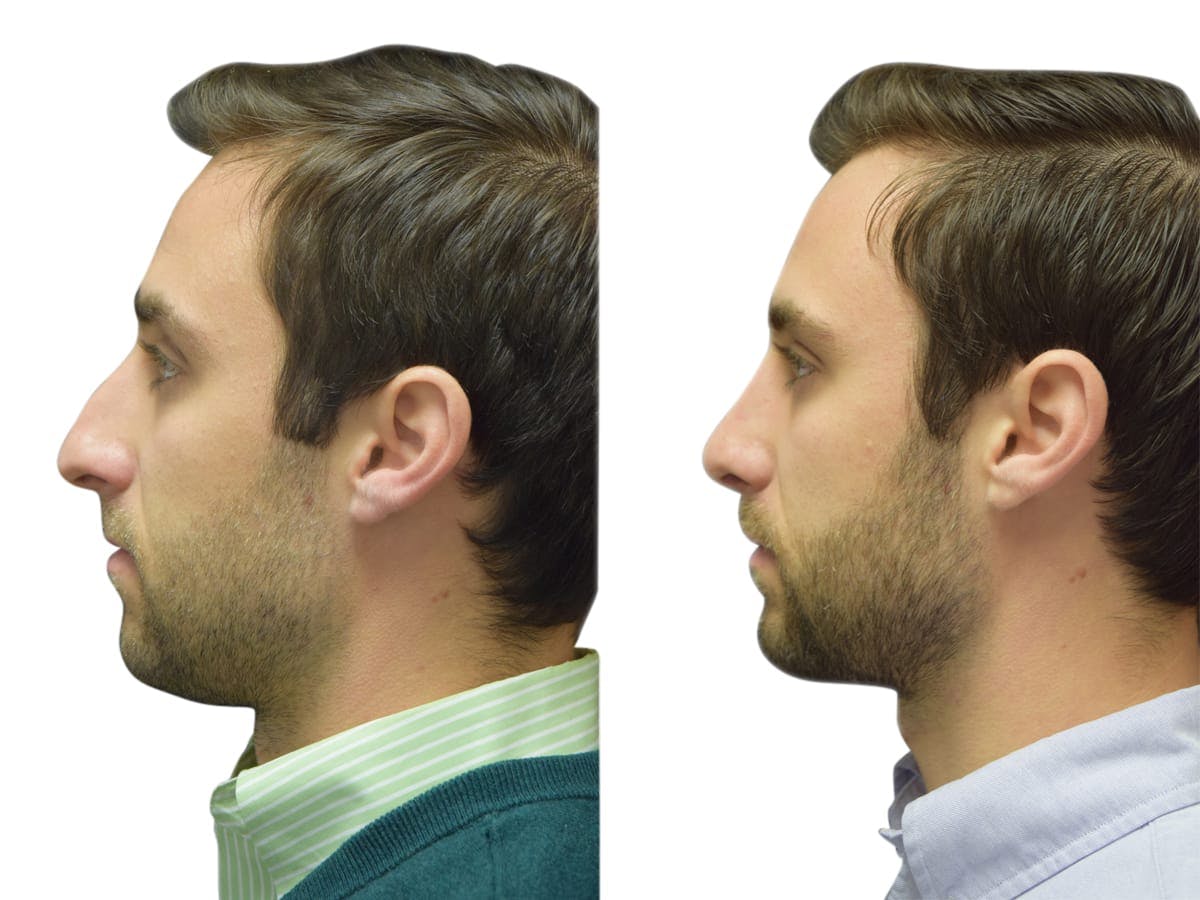 Rhinoplasty Before & After Gallery - Patient 310603 - Image 3