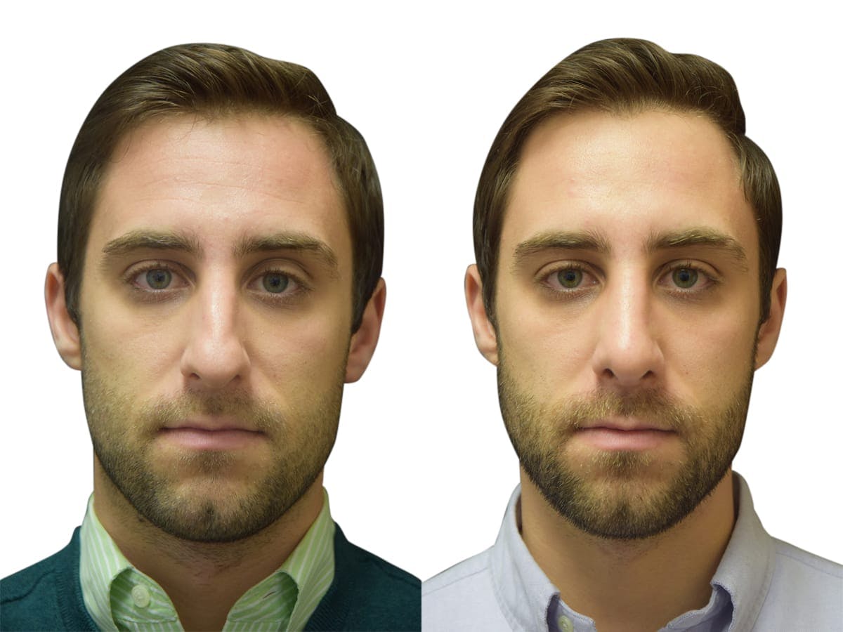 Rhinoplasty Before & After Gallery - Patient 310603 - Image 4
