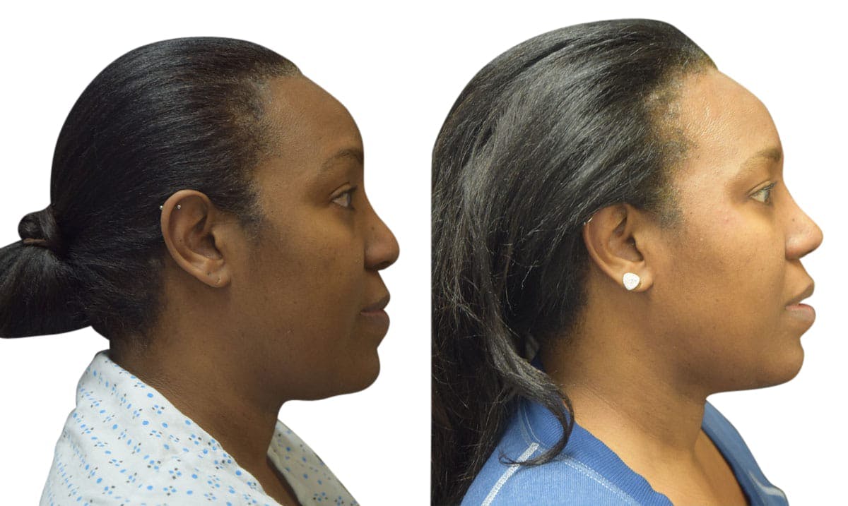 Rhinoplasty Before & After Gallery - Patient 297099 - Image 1