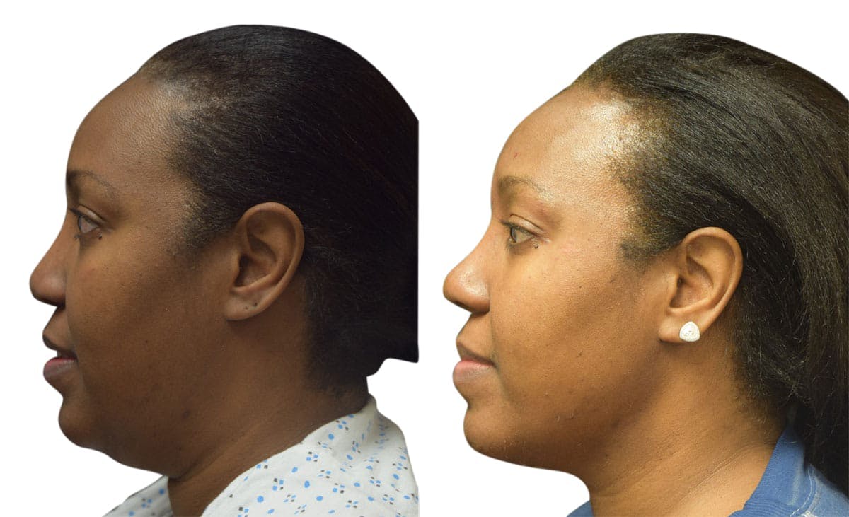 Rhinoplasty Before & After Gallery - Patient 297099 - Image 2