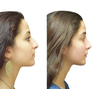Rhinoplasty Before & After Gallery - Patient 269738 - Image 1