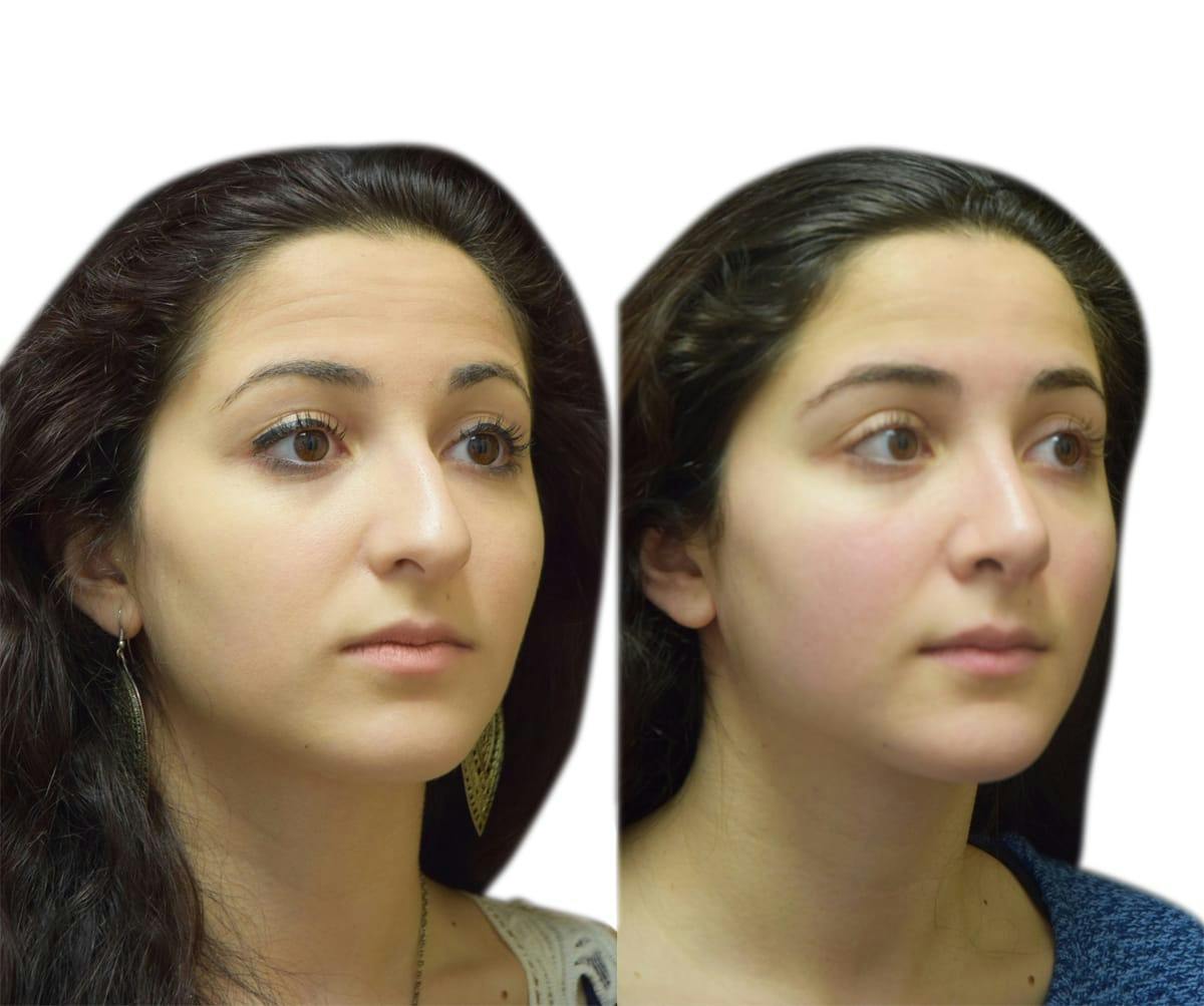 Rhinoplasty Before & After Gallery - Patient 269738 - Image 2