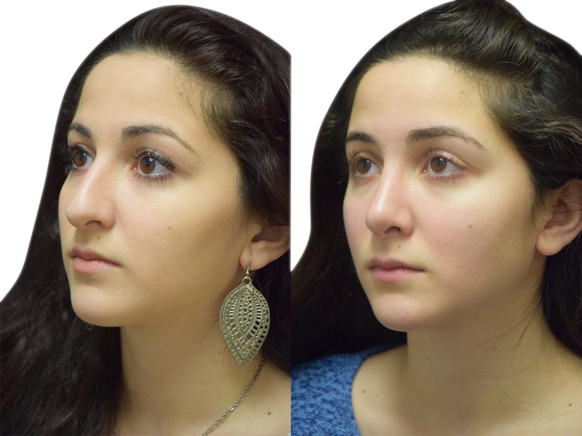 Rhinoplasty Before & After Gallery - Patient 269738 - Image 3