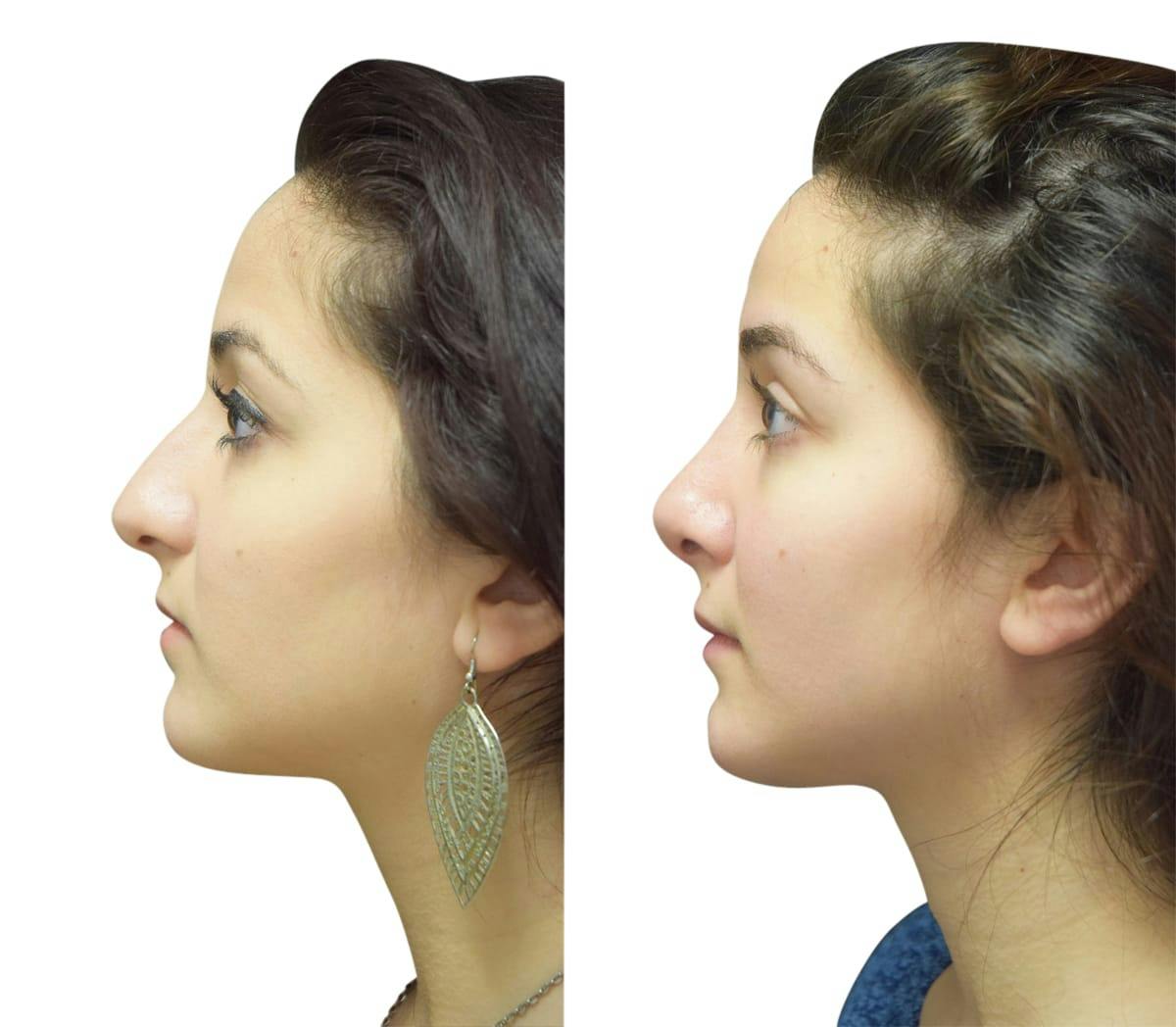 Rhinoplasty Before & After Gallery - Patient 269738 - Image 4
