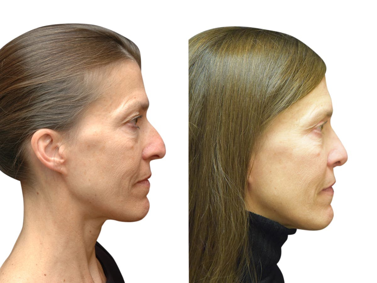 Rhinoplasty Before & After Gallery - Patient 294290 - Image 1
