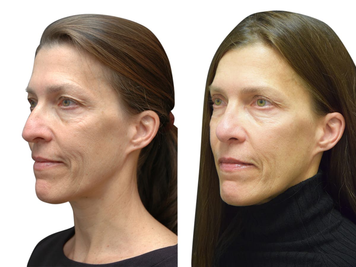 Rhinoplasty Before & After Gallery - Patient 294290 - Image 2