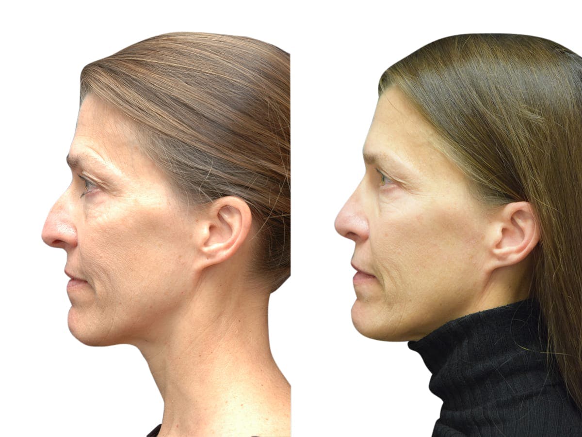 Rhinoplasty Before & After Gallery - Patient 294290 - Image 3