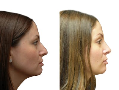 Rhinoplasty Before & After Gallery - Patient 387404 - Image 1