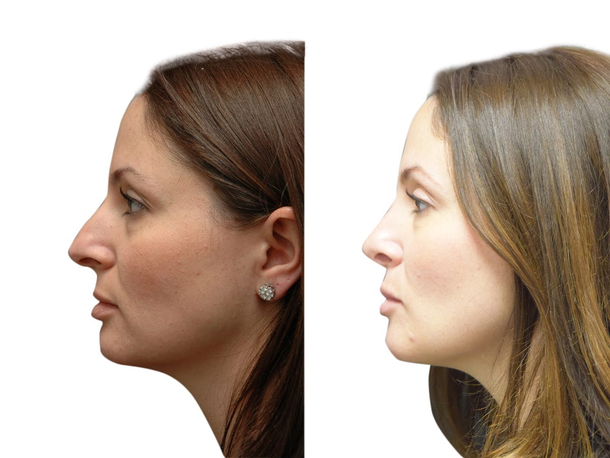 Rhinoplasty Before & After Gallery - Patient 387404 - Image 2