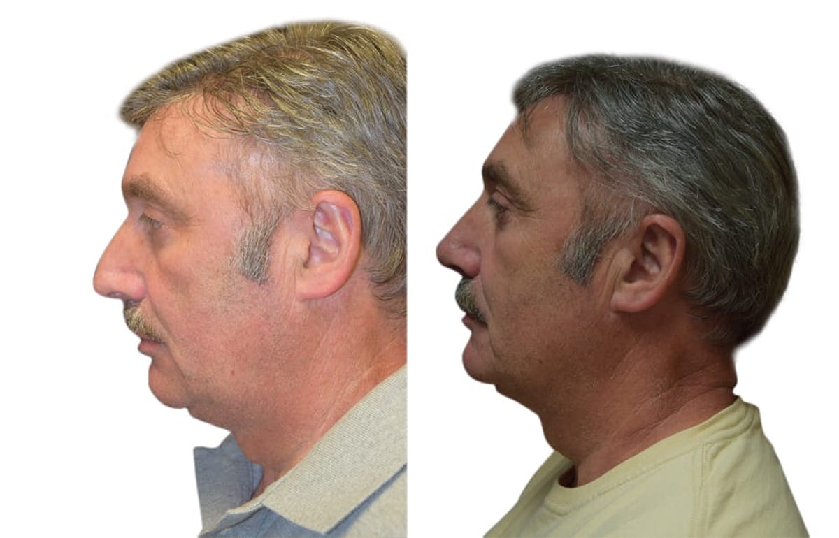 Rhinoplasty Before & After Gallery - Patient 165604 - Image 1