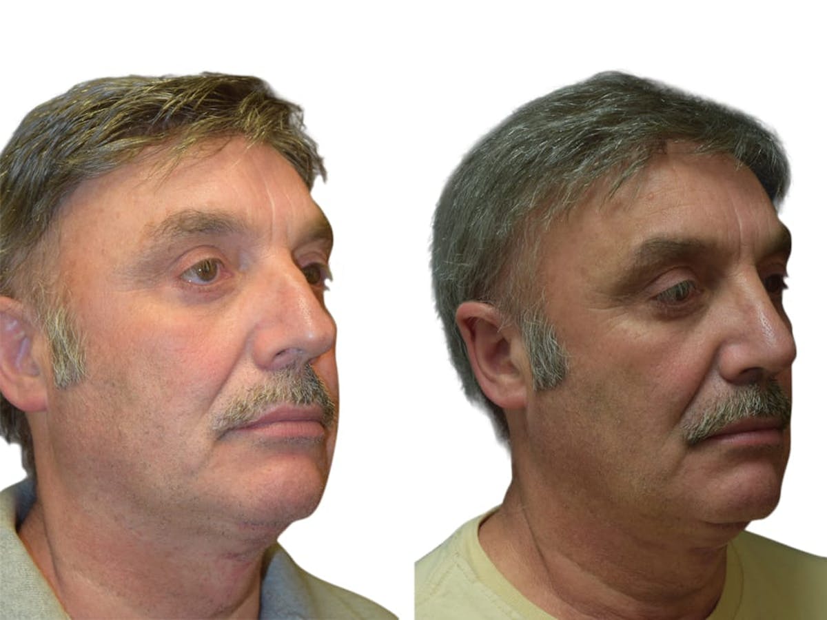 Rhinoplasty Before & After Gallery - Patient 165604 - Image 2