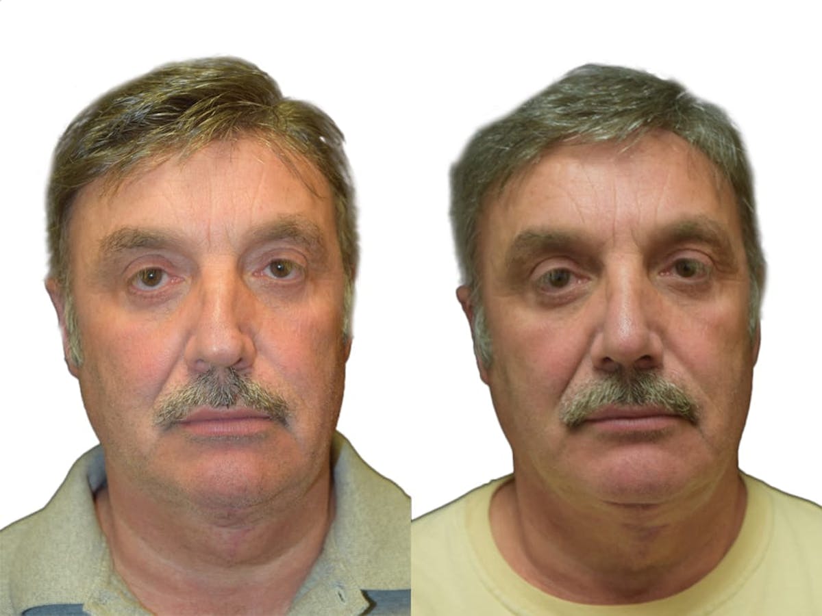 Rhinoplasty Before & After Gallery - Patient 165604 - Image 3