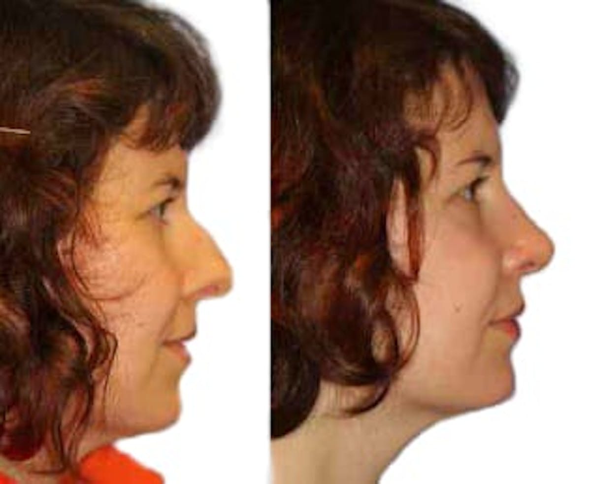 Rhinoplasty Before & After Gallery - Patient 287864 - Image 1