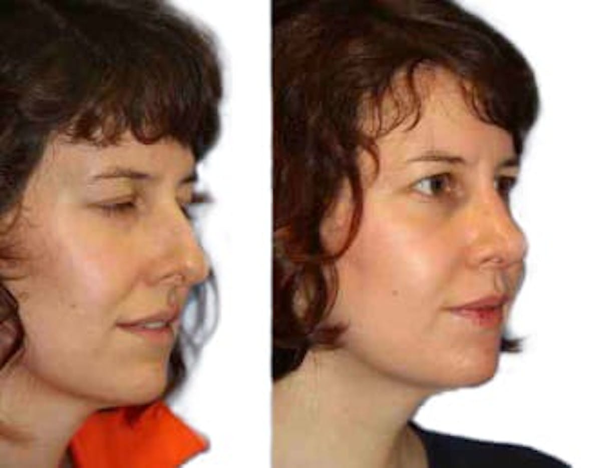 Rhinoplasty Before & After Gallery - Patient 287864 - Image 2