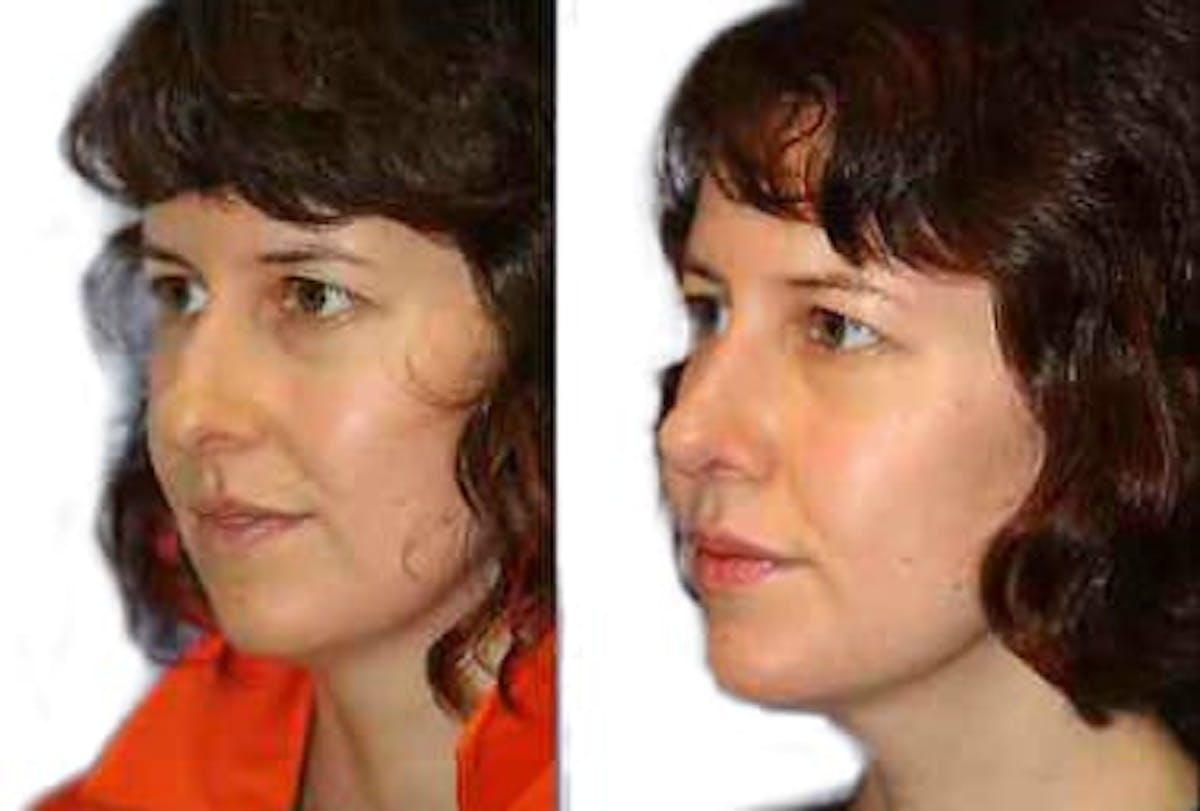 Rhinoplasty Before & After Gallery - Patient 287864 - Image 3