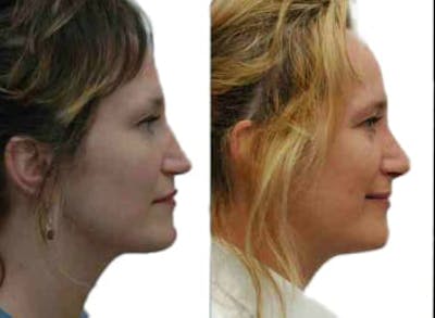 Rhinoplasty Before & After Gallery - Patient 313904 - Image 1