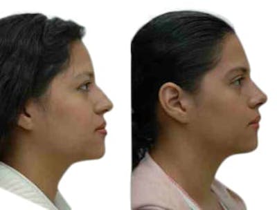 Rhinoplasty Before & After Gallery - Patient 156452 - Image 1