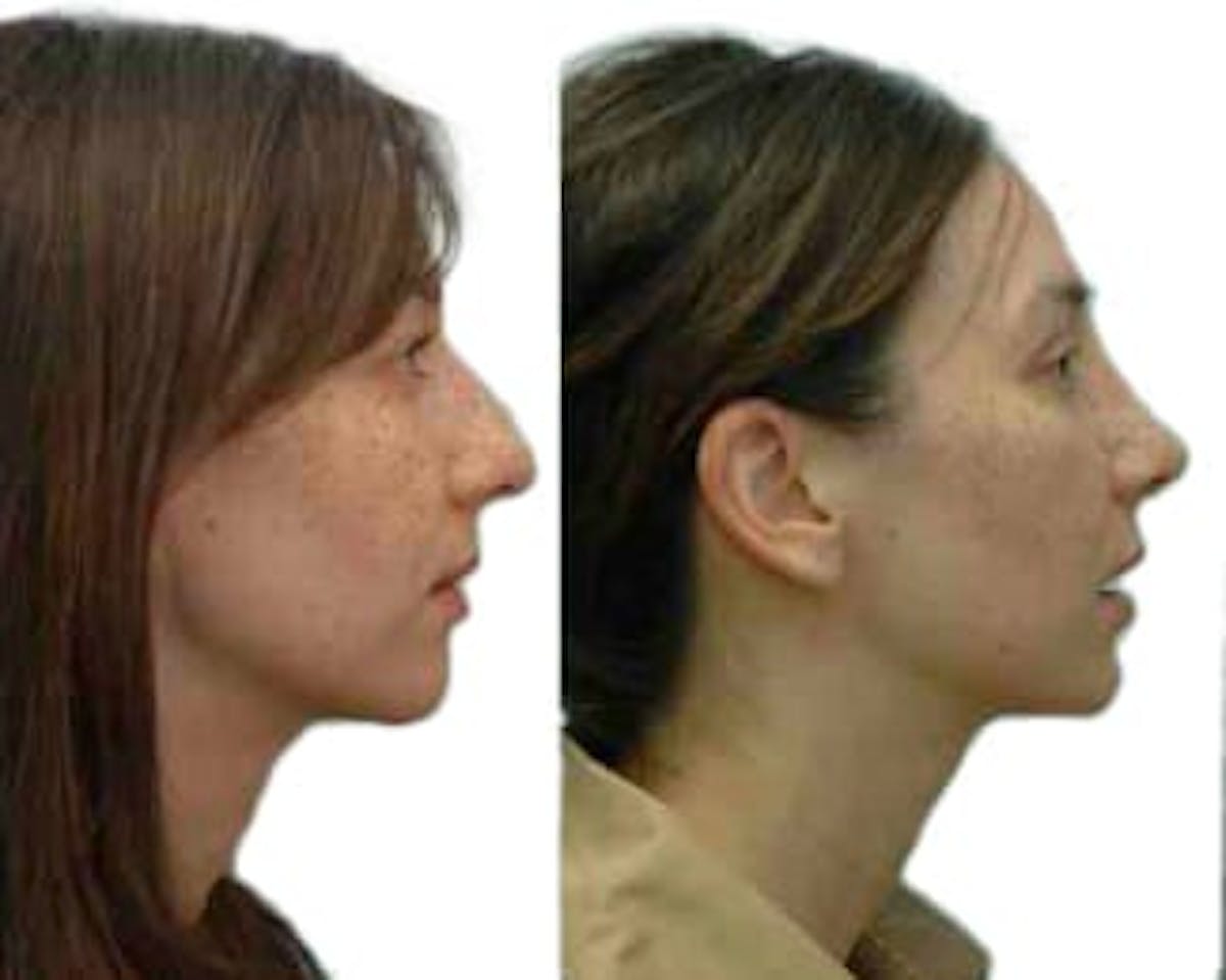 Rhinoplasty Before & After Gallery - Patient 282408 - Image 2