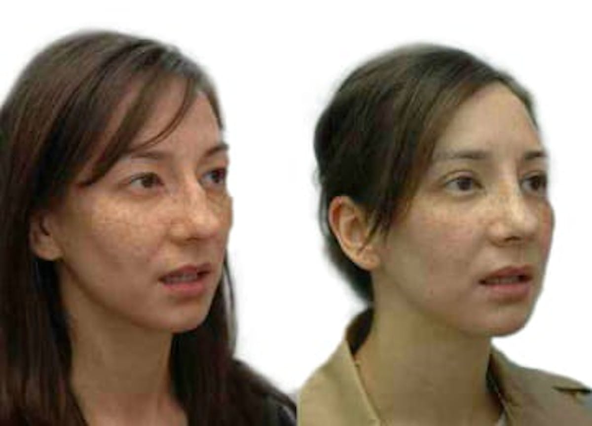 Rhinoplasty Before & After Gallery - Patient 282408 - Image 3