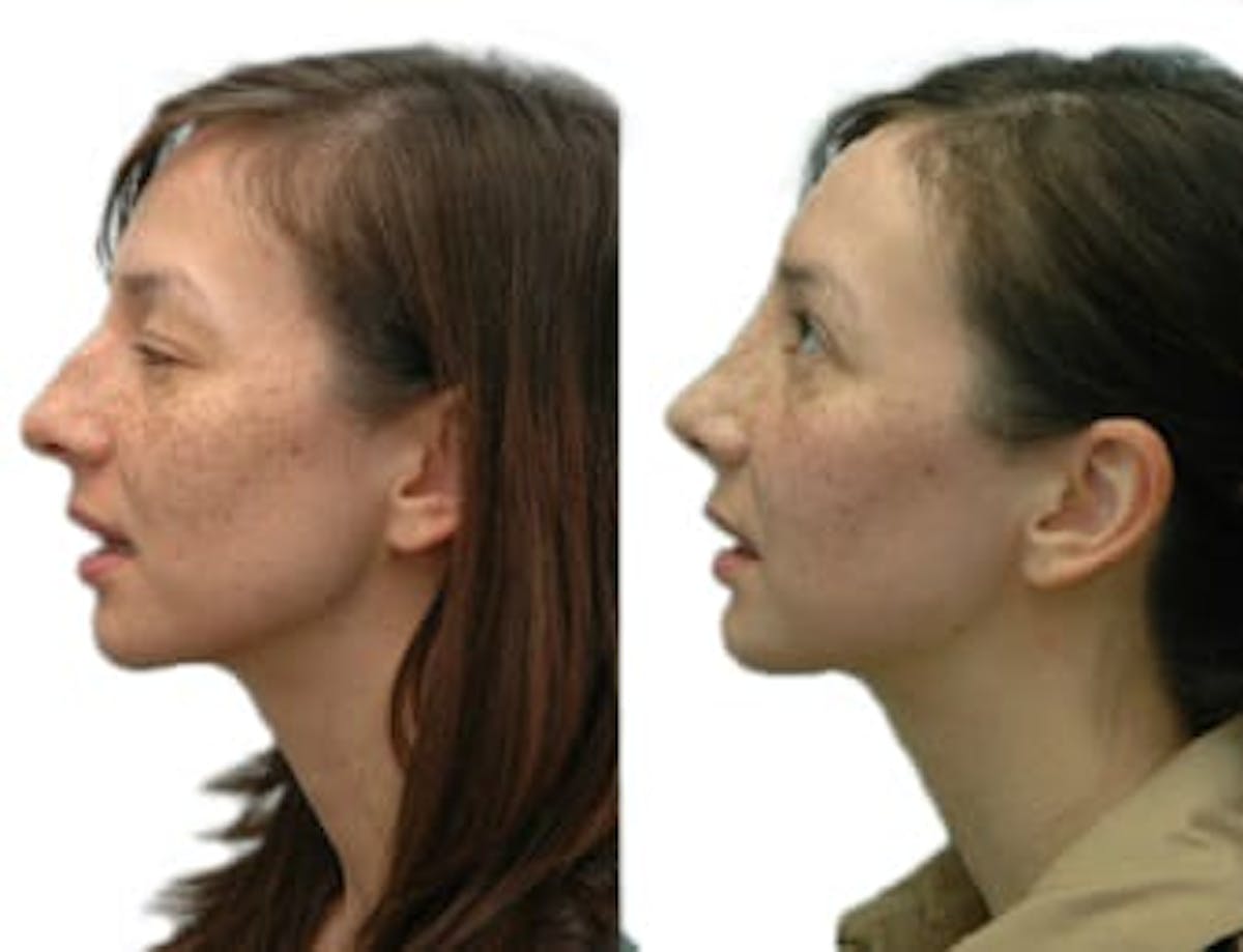 Rhinoplasty Before & After Gallery - Patient 282408 - Image 1
