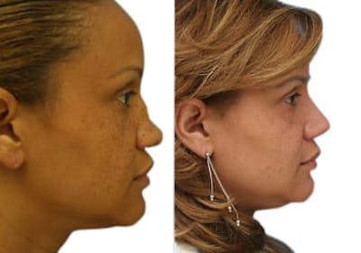 Rhinoplasty Before & After Gallery - Patient 401092 - Image 1