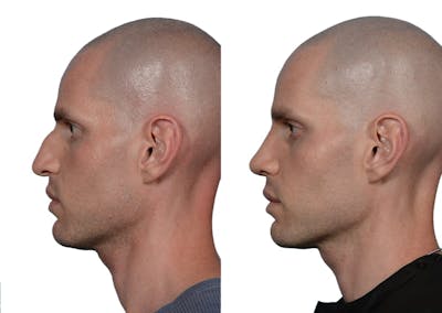 Rhinoplasty Before & After Gallery - Patient 363083 - Image 1