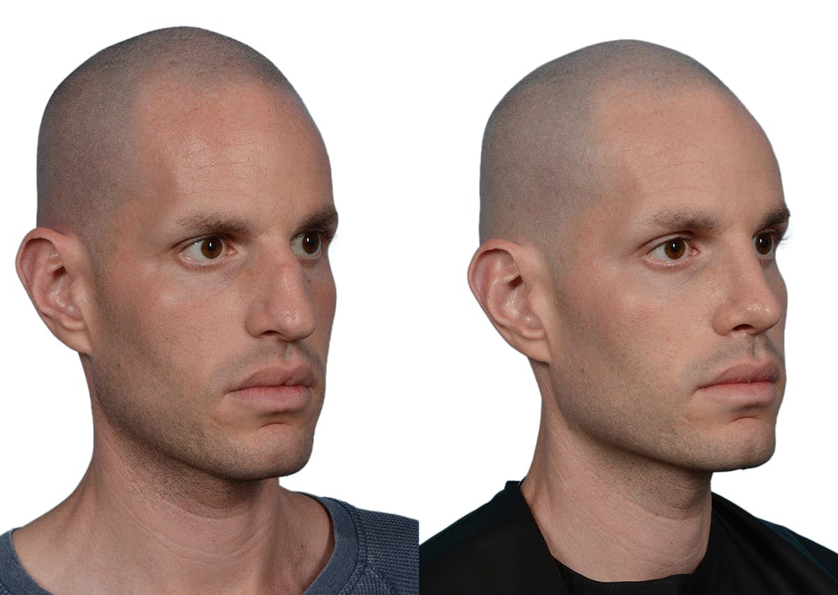 Rhinoplasty Before & After Gallery - Patient 363083 - Image 2