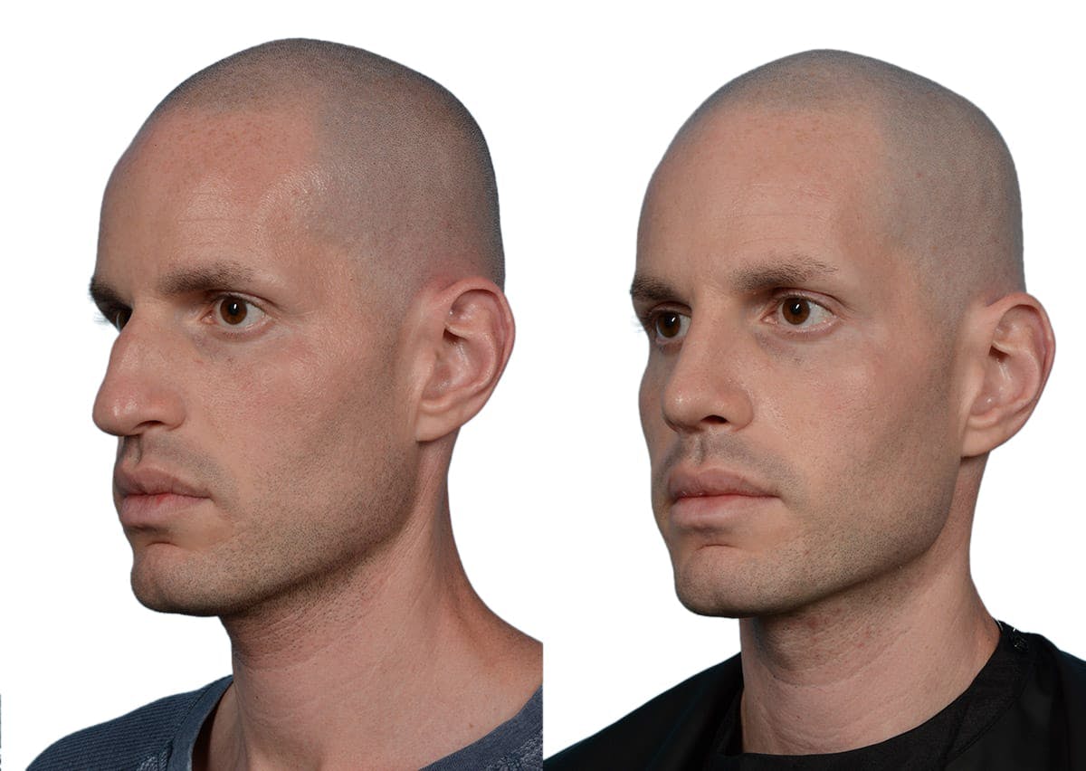 Rhinoplasty Before & After Gallery - Patient 363083 - Image 3