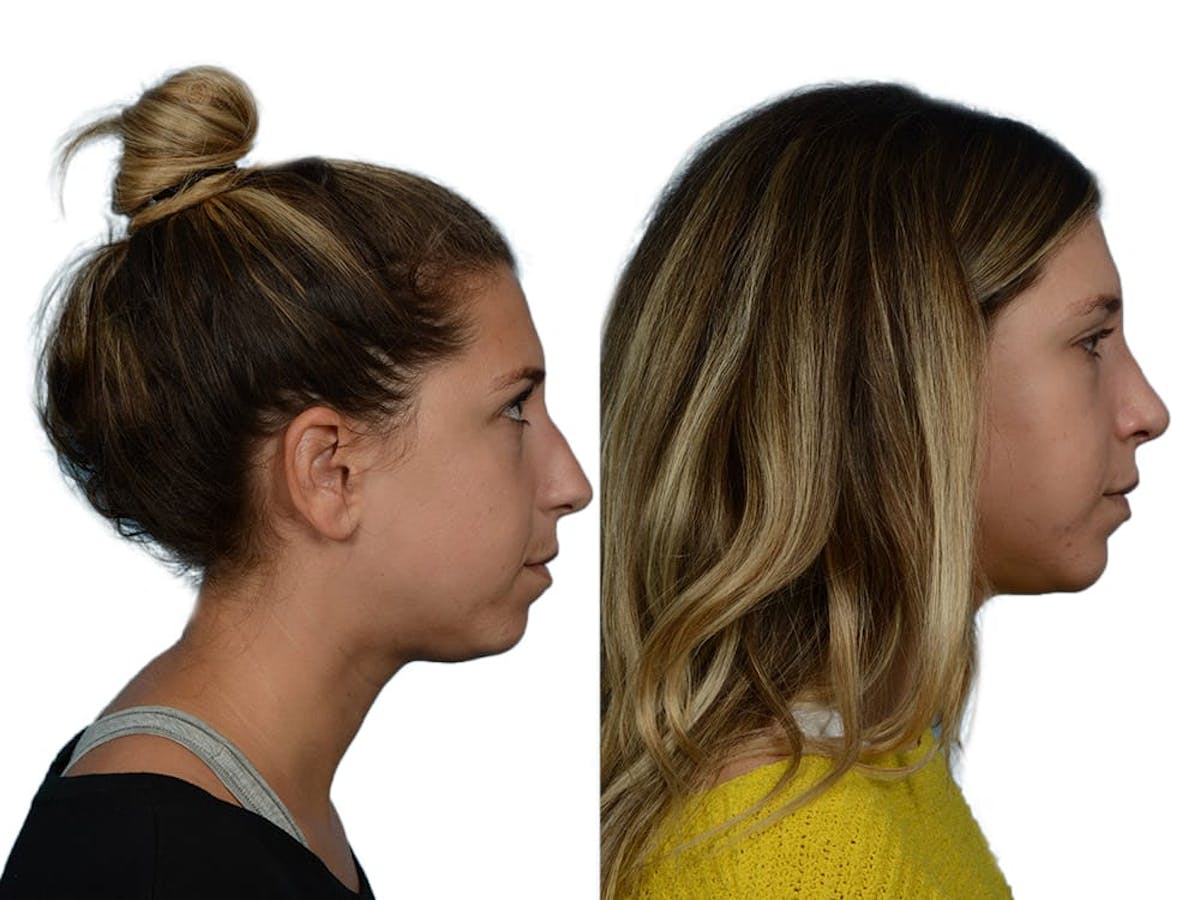 Rhinoplasty Before & After Gallery - Patient 281486 - Image 1