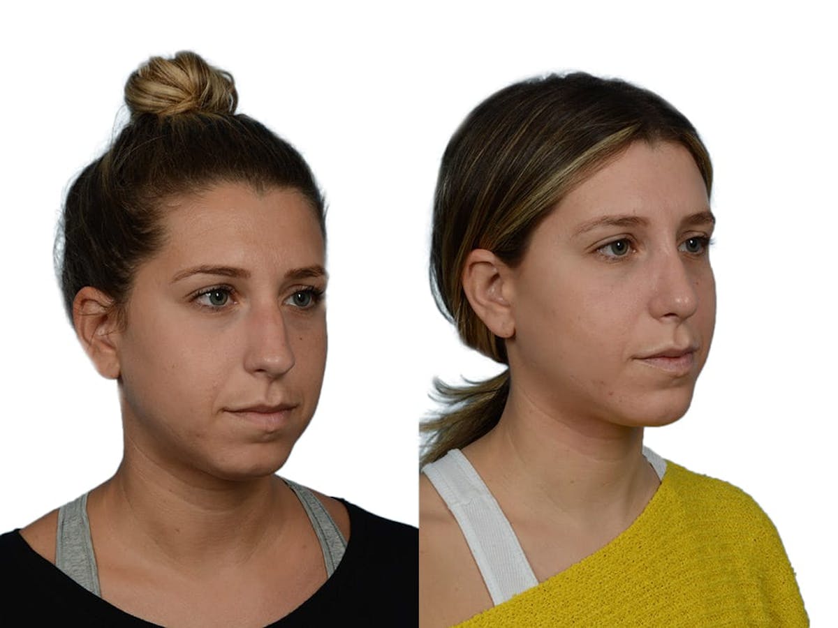 Rhinoplasty Before & After Gallery - Patient 281486 - Image 2
