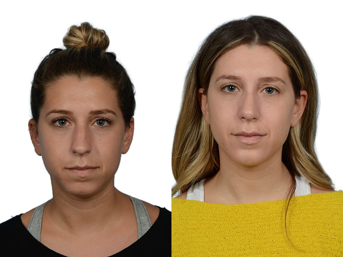 Rhinoplasty Before & After Gallery - Patient 281486 - Image 3