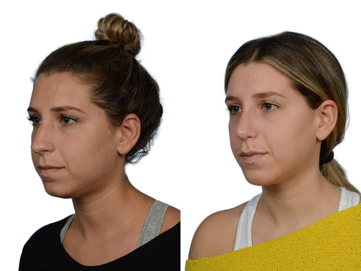 Rhinoplasty Before & After Gallery - Patient 281486 - Image 4