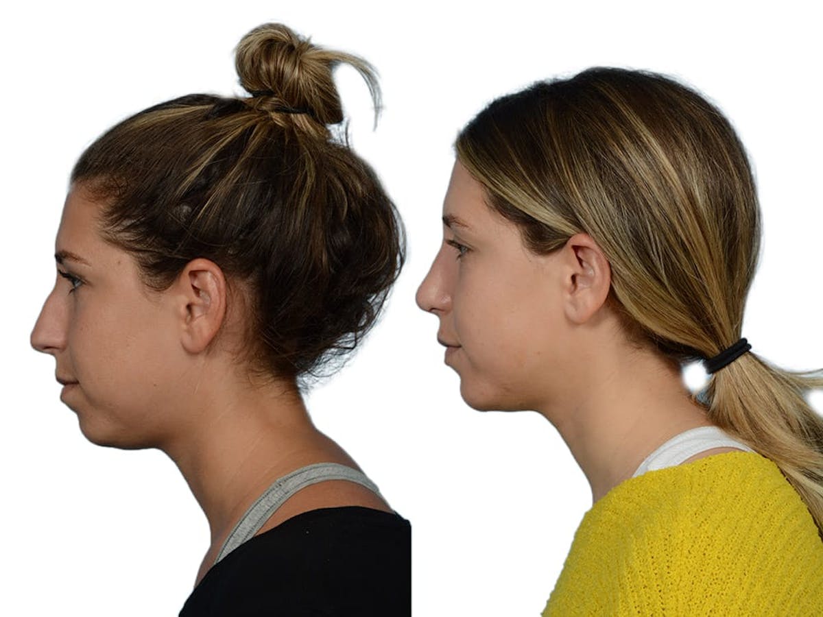 Rhinoplasty Before & After Gallery - Patient 281486 - Image 5
