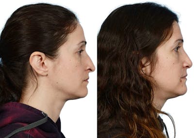 Rhinoplasty Before & After Gallery - Patient 287858 - Image 1