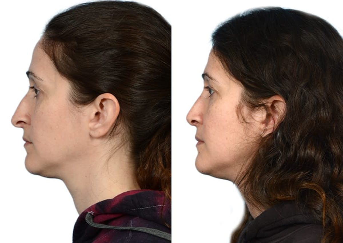 Rhinoplasty Before & After Gallery - Patient 287858 - Image 2