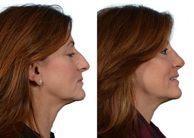 Rhinoplasty Before & After Gallery - Patient 401350 - Image 1