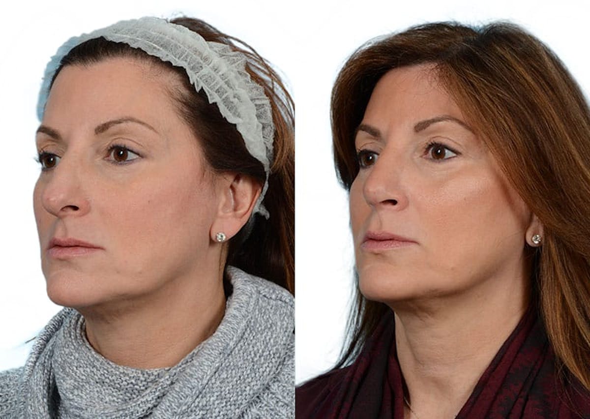 Rhinoplasty Before & After Gallery - Patient 401350 - Image 2