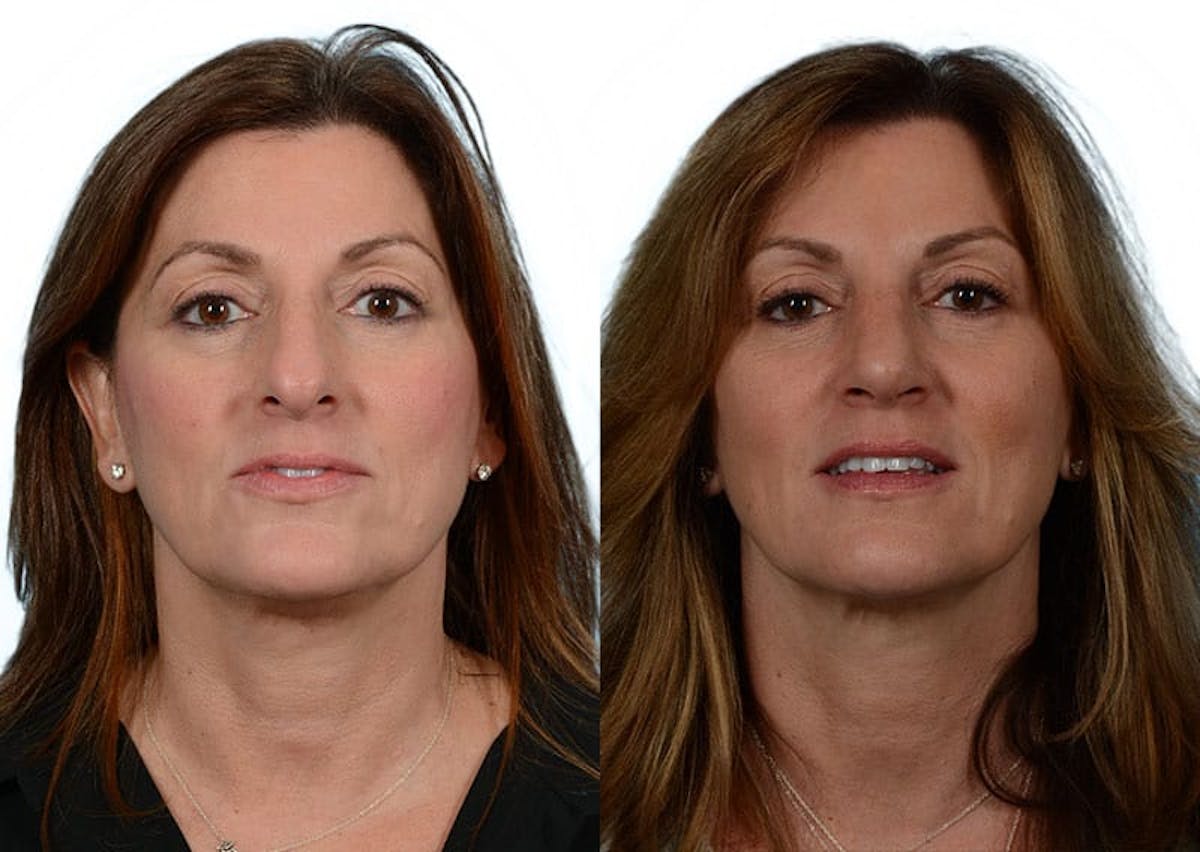 Rhinoplasty Before & After Gallery - Patient 401350 - Image 3