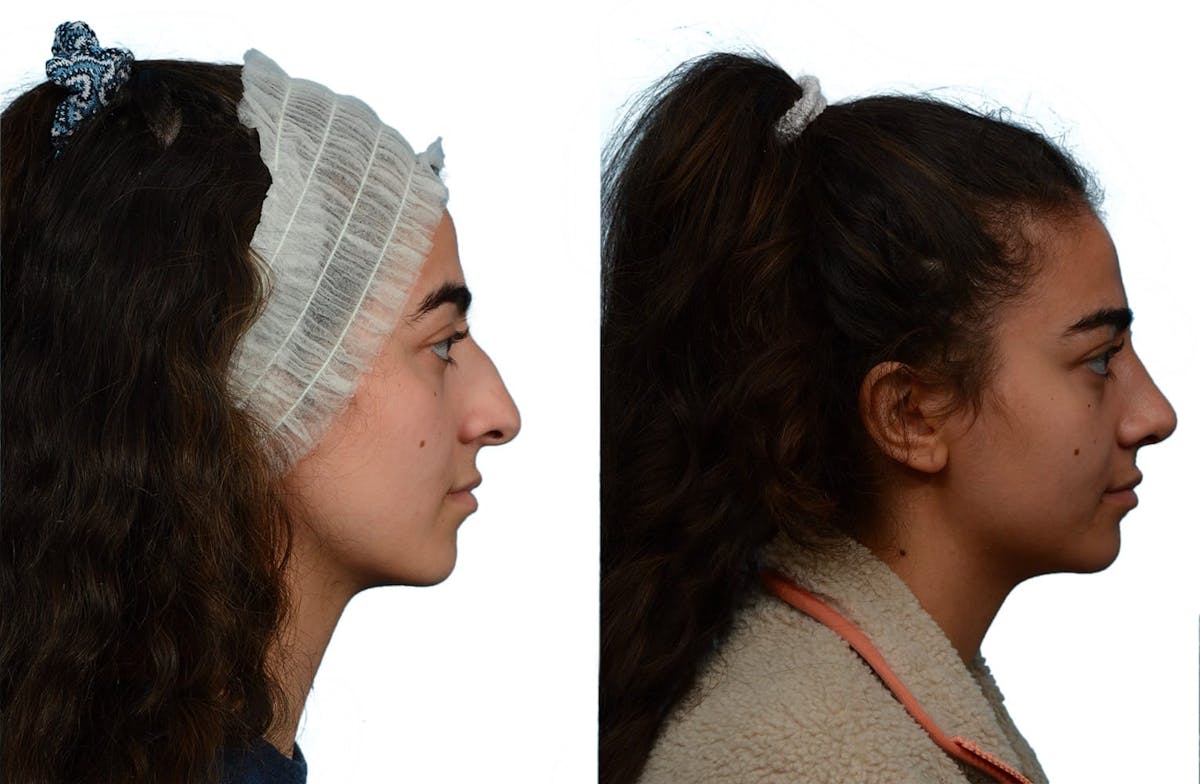 Rhinoplasty Before & After Gallery - Patient 345579 - Image 1