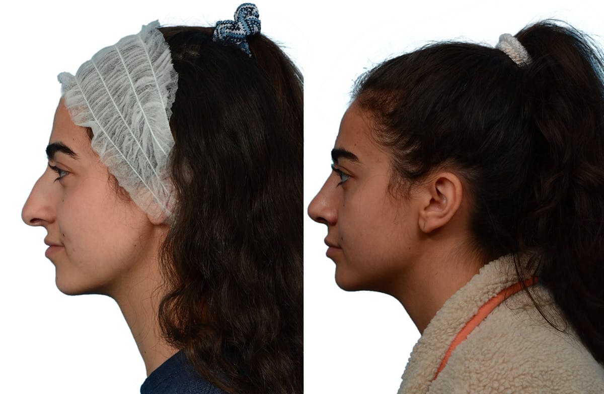 Rhinoplasty Before & After Gallery - Patient 345579 - Image 3