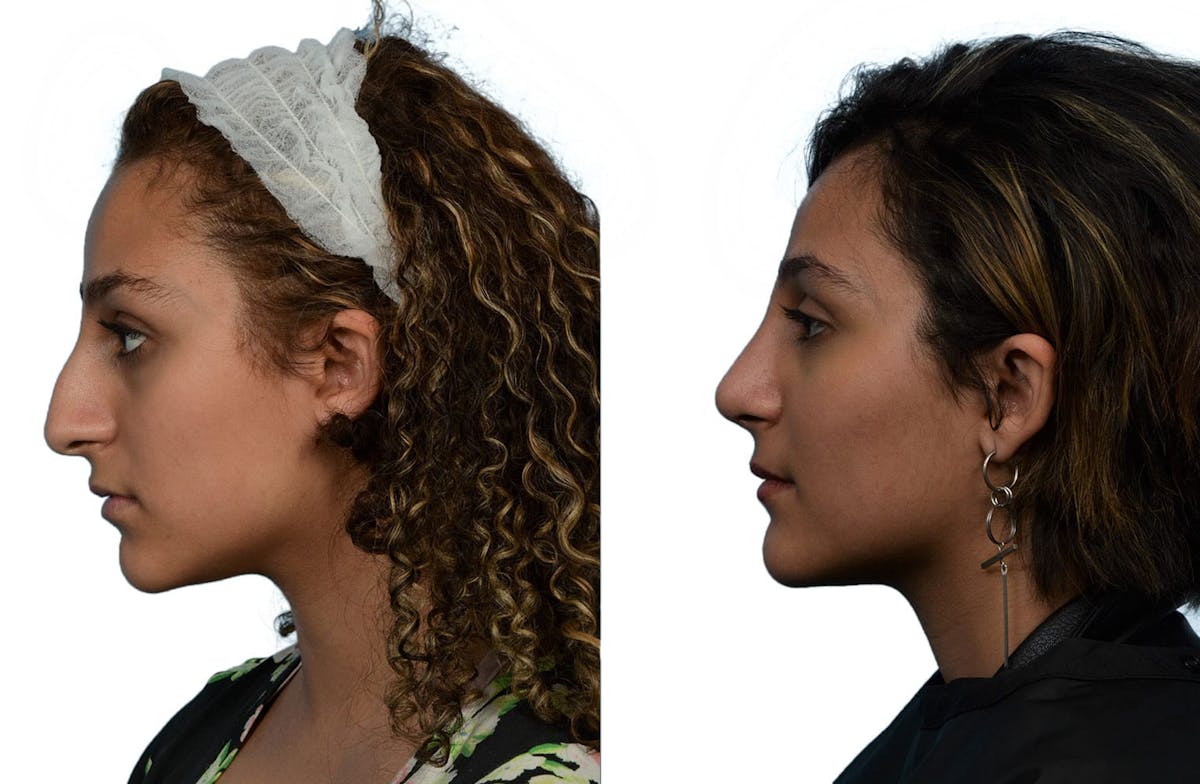 Rhinoplasty Before & After Gallery - Patient 222180 - Image 1