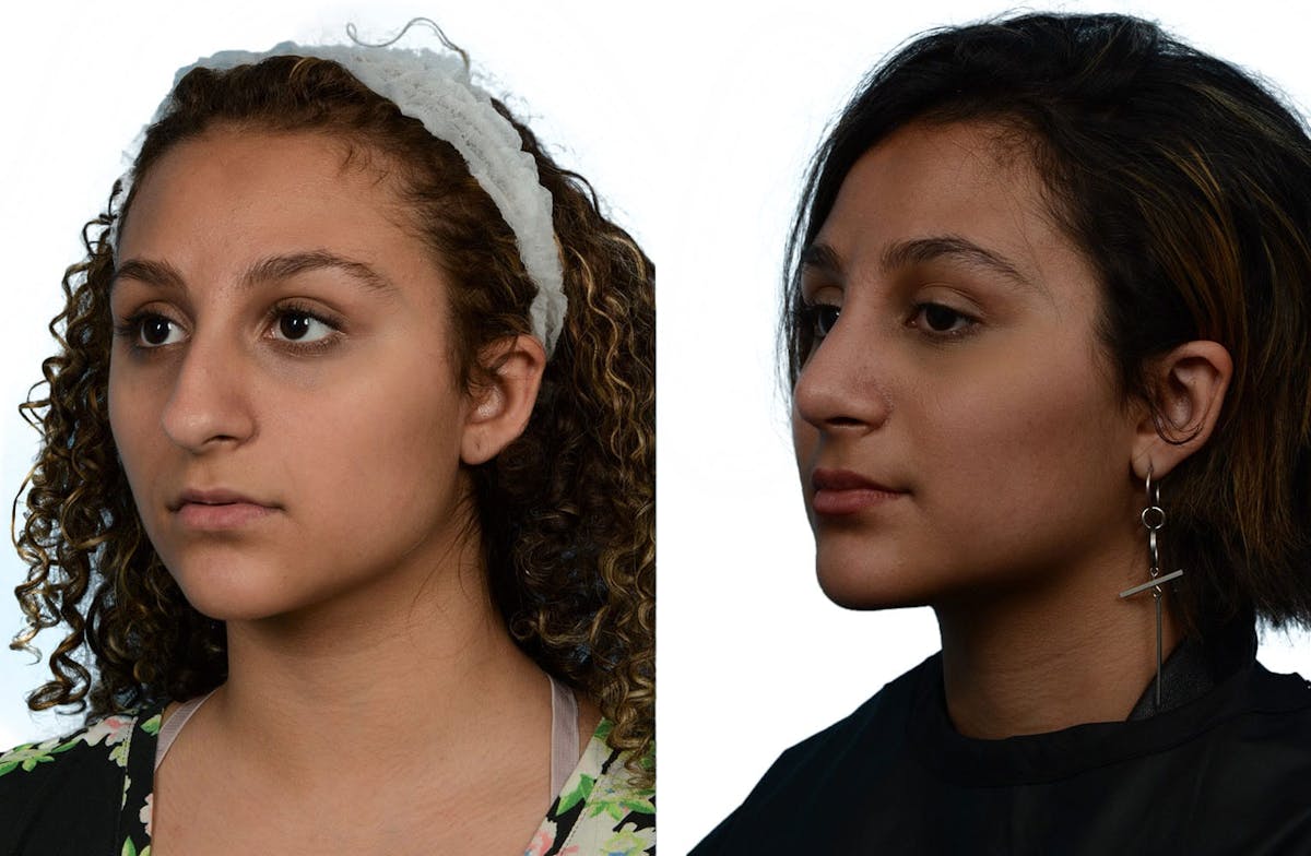 Rhinoplasty Before & After Gallery - Patient 222180 - Image 2
