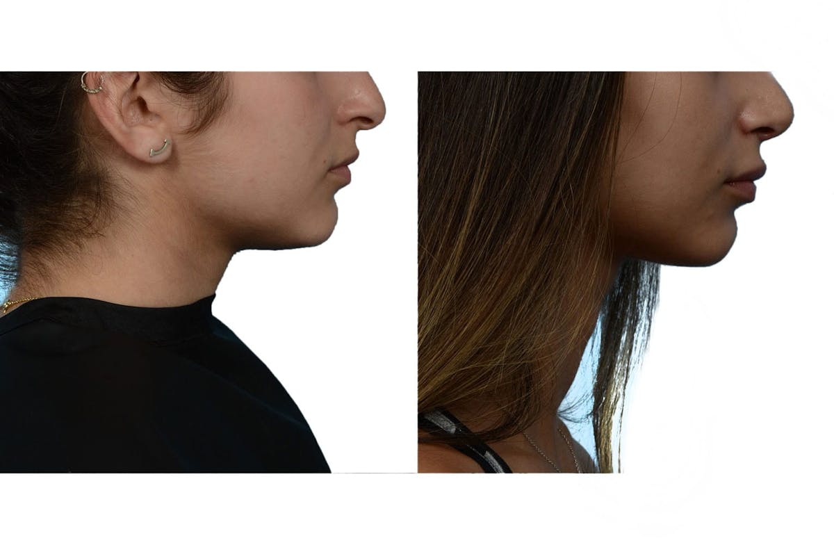 Rhinoplasty Before & After Gallery - Patient 252712 - Image 1