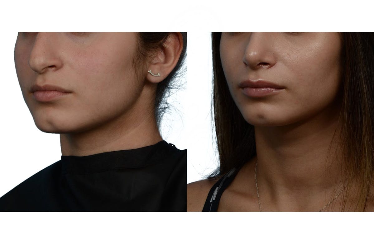 Rhinoplasty Before & After Gallery - Patient 252712 - Image 2