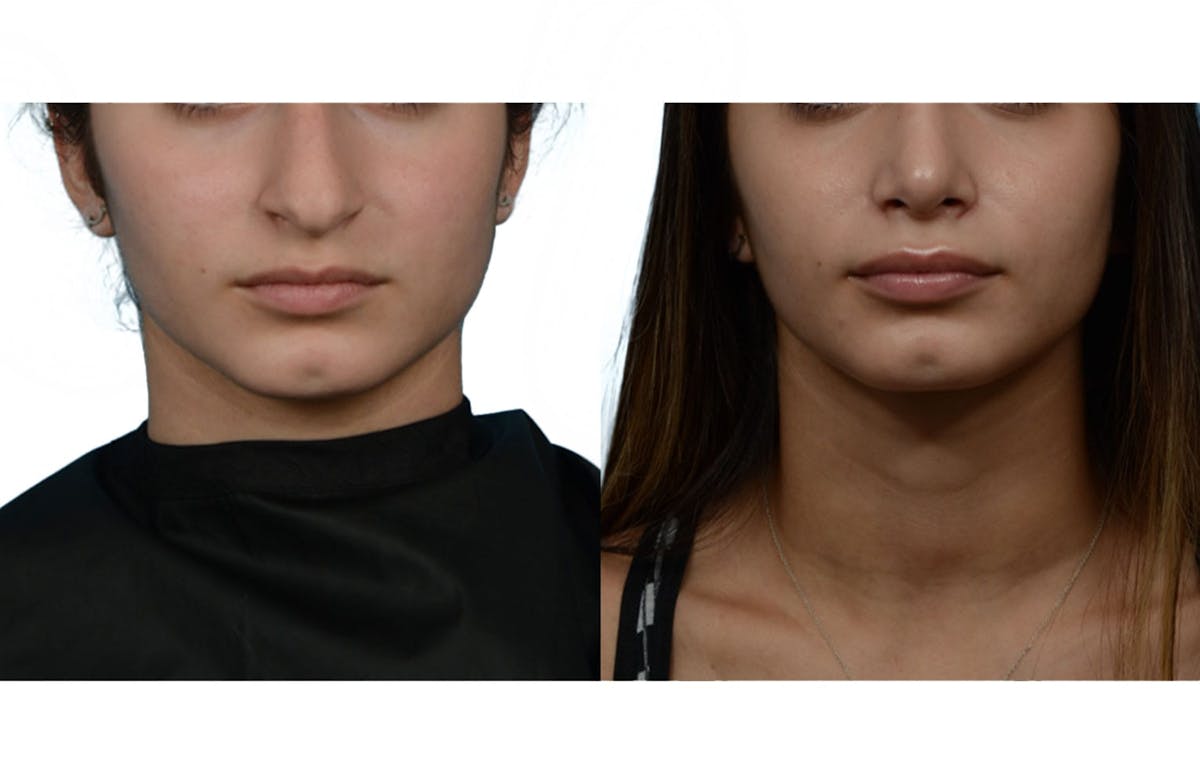 Rhinoplasty Before & After Gallery - Patient 252712 - Image 3