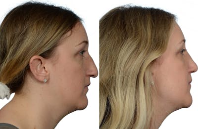 Rhinoplasty Before & After Gallery - Patient 285141 - Image 1