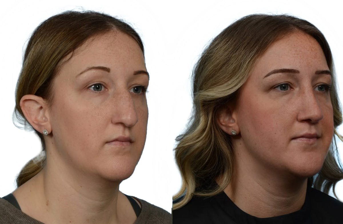 Rhinoplasty Before & After Gallery - Patient 285141 - Image 2