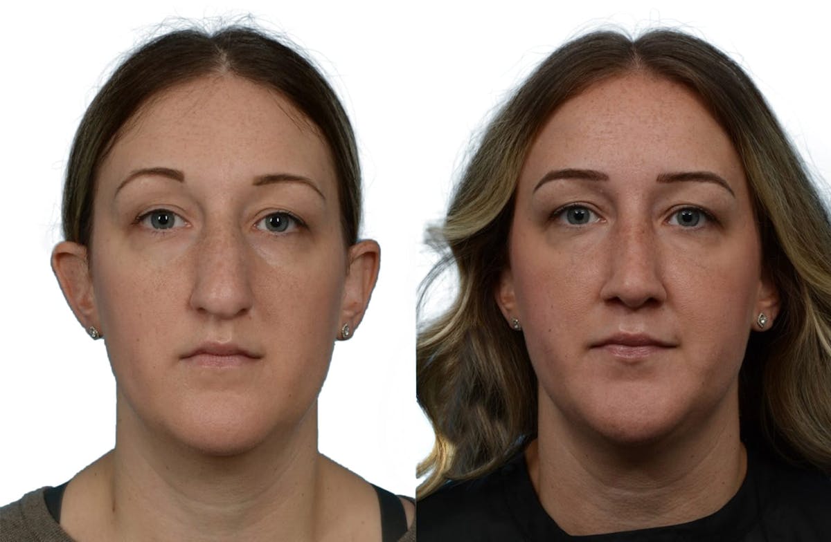 Rhinoplasty Before & After Gallery - Patient 285141 - Image 3