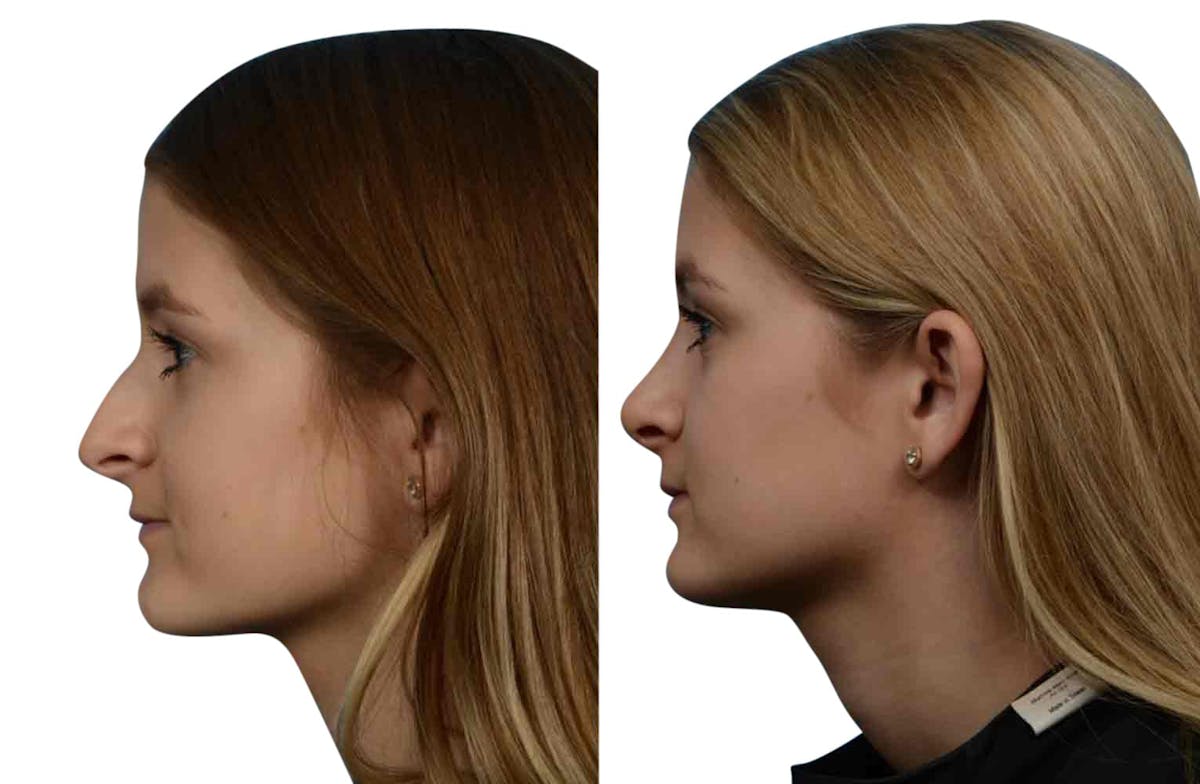Rhinoplasty Before & After Gallery - Patient 213435 - Image 1